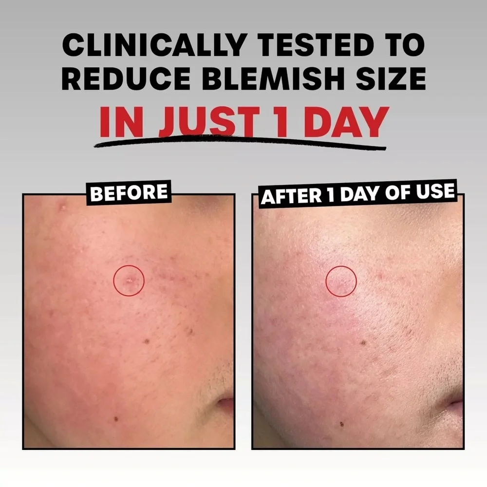 Thayer’s Rapid Acne Treatment .68oz